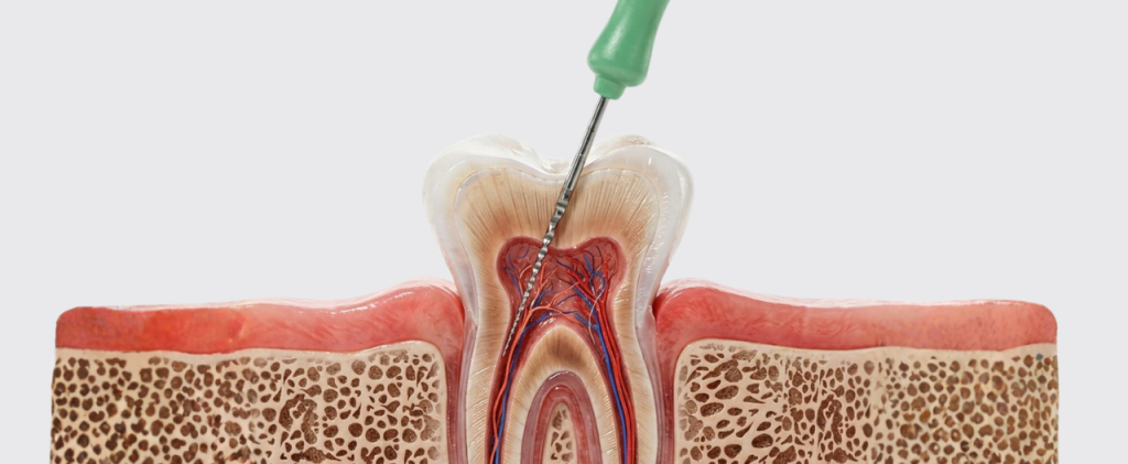 5 Signs Your Tooth Pain Might Need a Root Canal